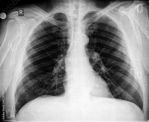 xray of chest