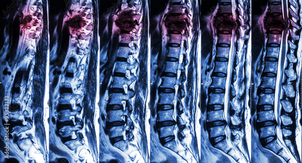 MRI of Lumbar & Thoracic spine : show fracture of thoracic spine and ...