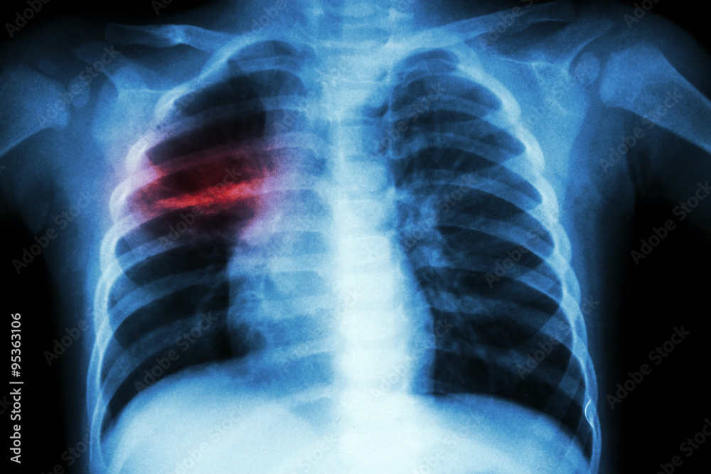 Pulmonary Tuberculosis ( Chest X-ray of child : show patchy infiltration at right middle lung ) Pulmonary Tuberculosis ( Chest X-ray of child : show patchy infiltration at right middle lung )