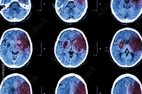 Ischemic stroke : ( CT of brain show cerebral infarction at left frontal - temporal - parietal lobe ) ( nervous system background ) photo