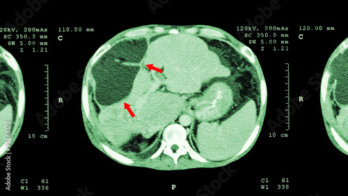CT scan of upper abdomen : show abnormal mass at liver ( Liver cancer )