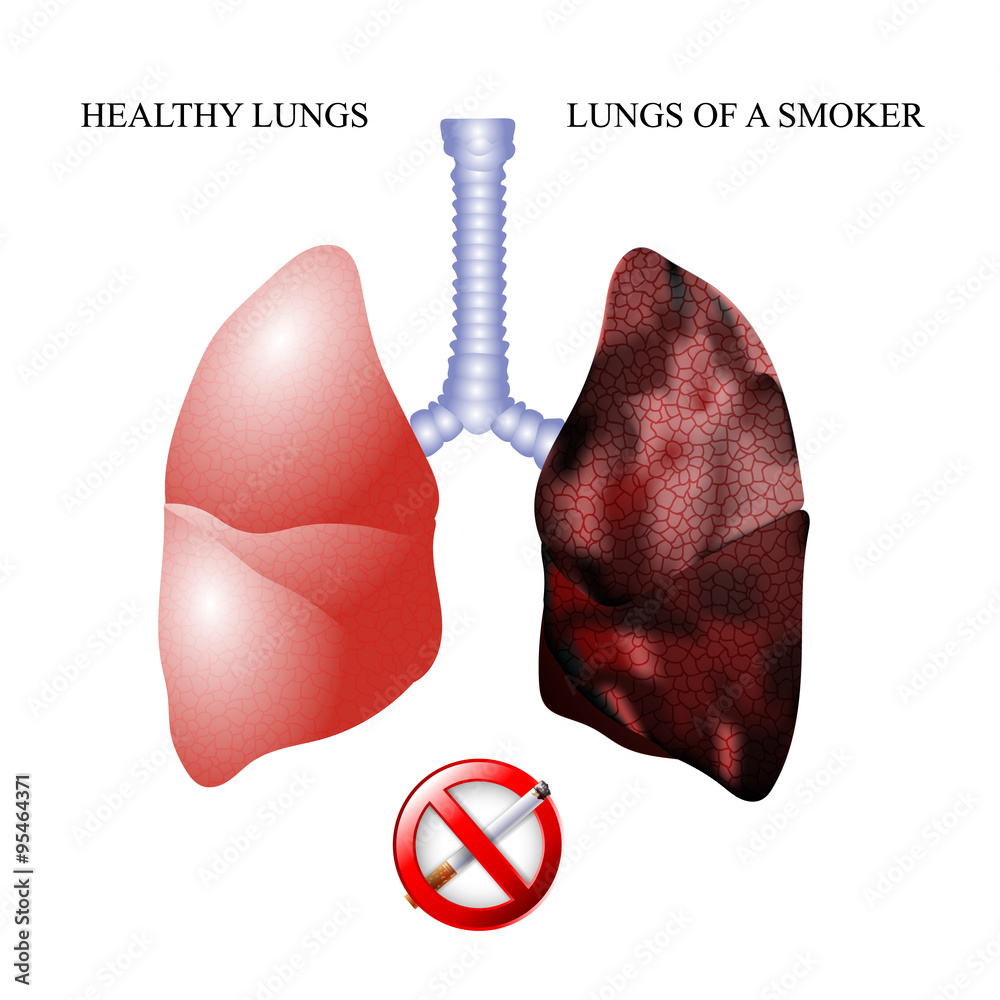 the lungs of a healthy person and smoker alveoli Stock Vector | Adobe Stock