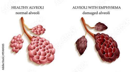 the lungs of a healthy person and smoker alveoli
