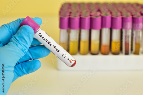 Coxsackie virus positive blood sample photo