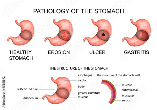 pathology of the stomach photo