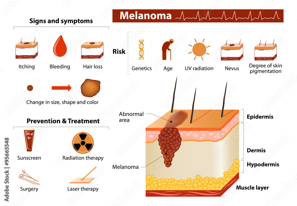 Skin cancer infographics