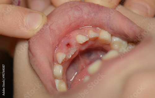 Young caucasian girl after dental extraction.