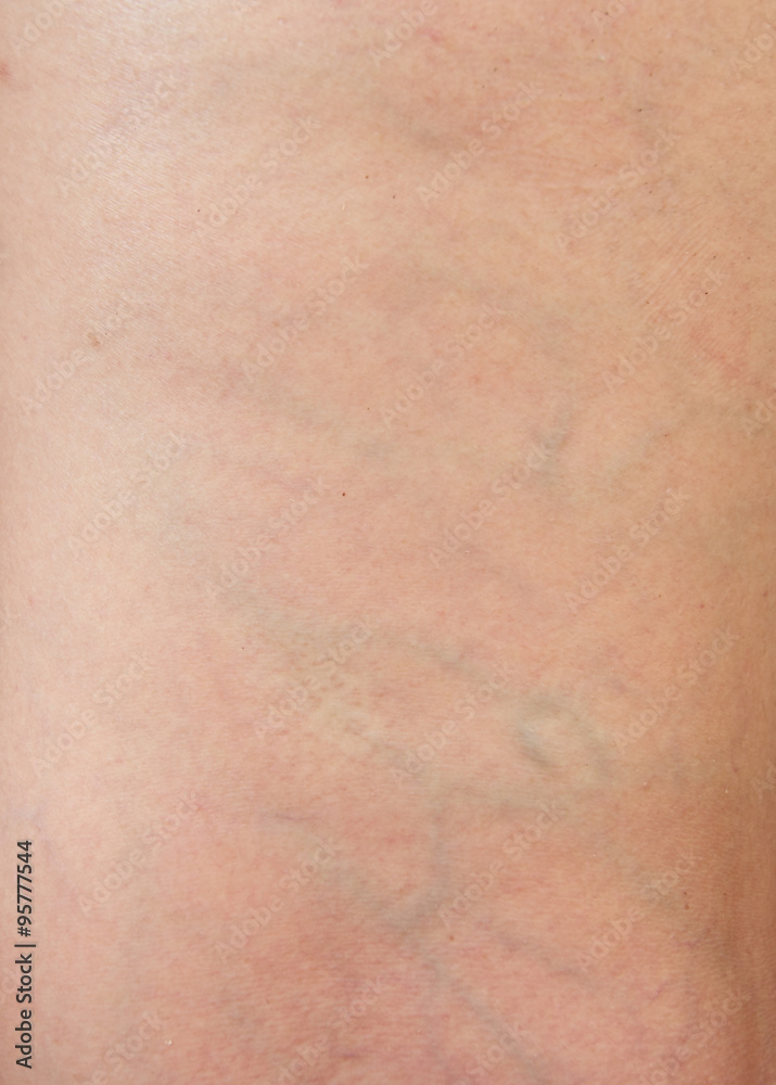 varicose veins on the skin varicose veins on the skin