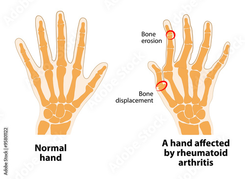 Normal hand and Rheumatoid Arthritis