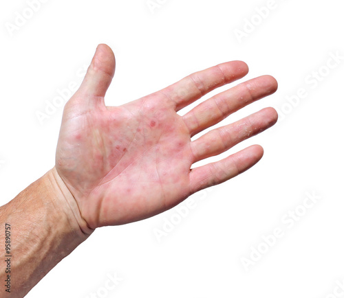 Palm patient erythema in red spots from inflammation