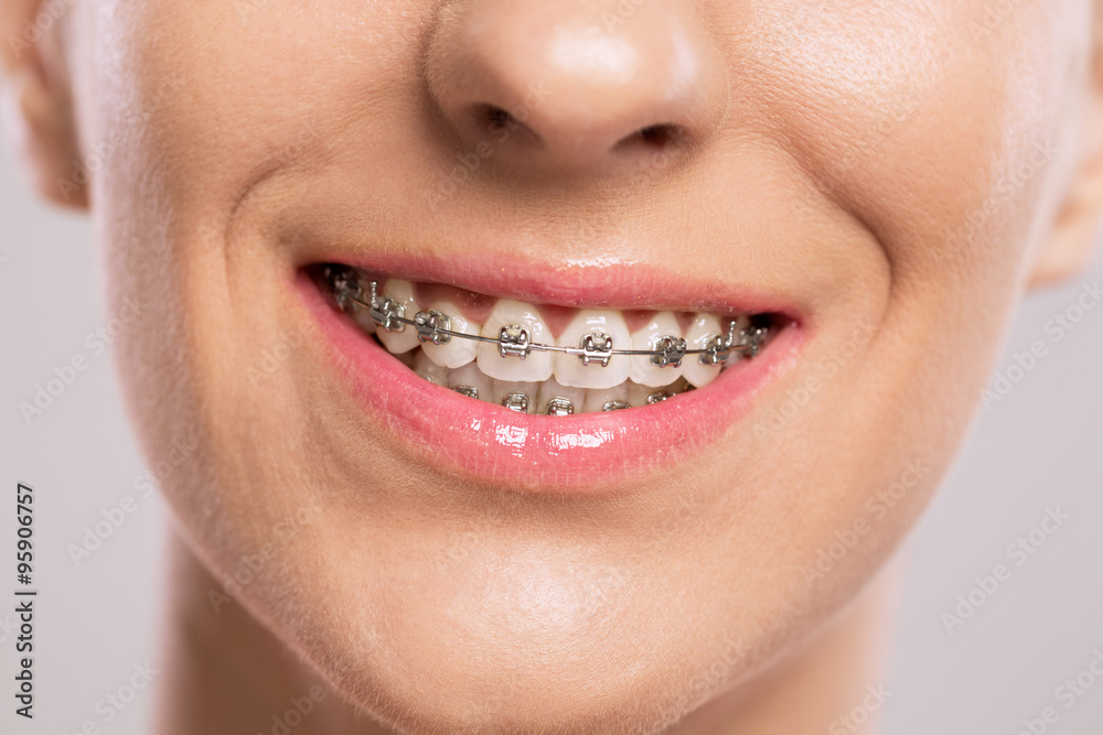 Obraz premium Healthy smile with braces