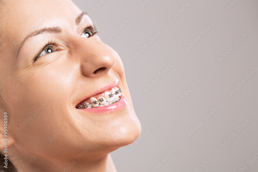 Fototapeta premium Young beautiful girl with braces on teeth