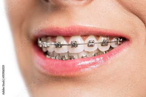 Teeth with braces