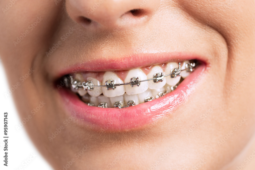 Fototapeta premium Prety girl smiling with braces