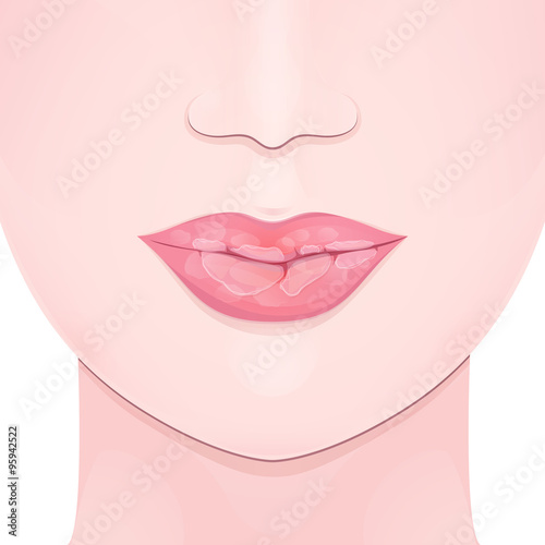 dry cracked lips