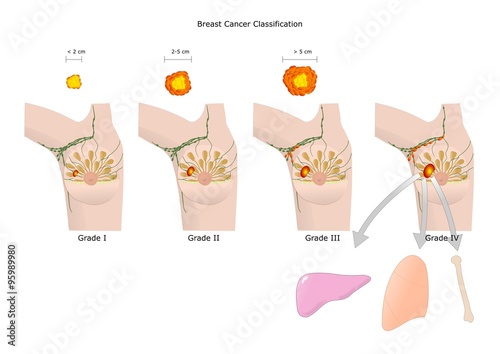 stadiazione del cancro al seno