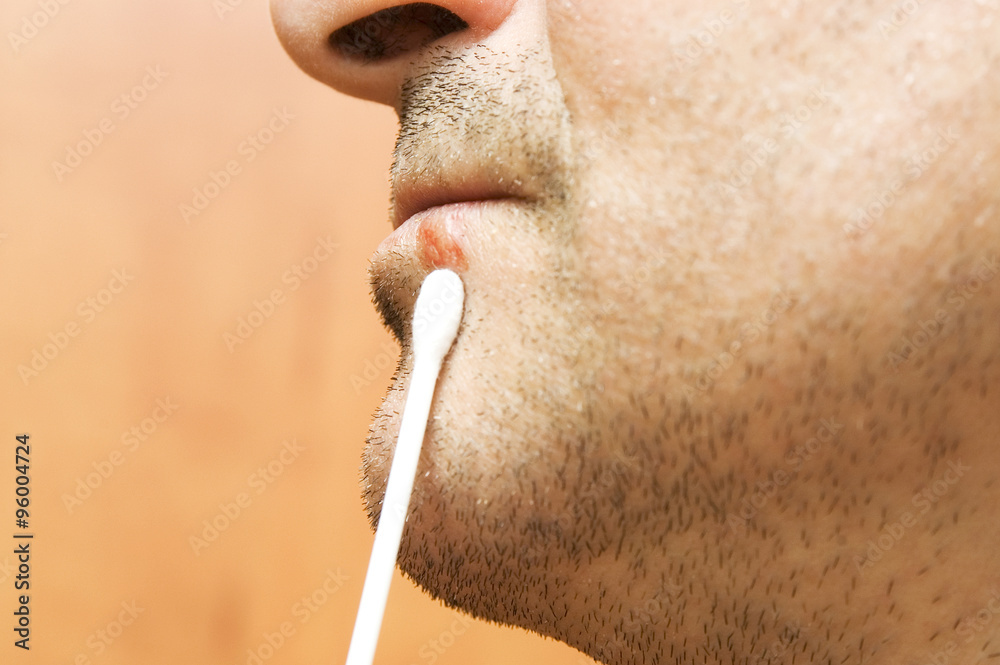 Obraz premium Lips affected by herpes