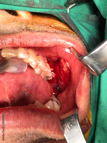 wide excision oral cavity cancer