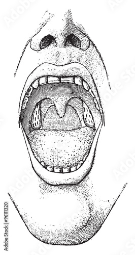 Tonsils, vintage engraving.