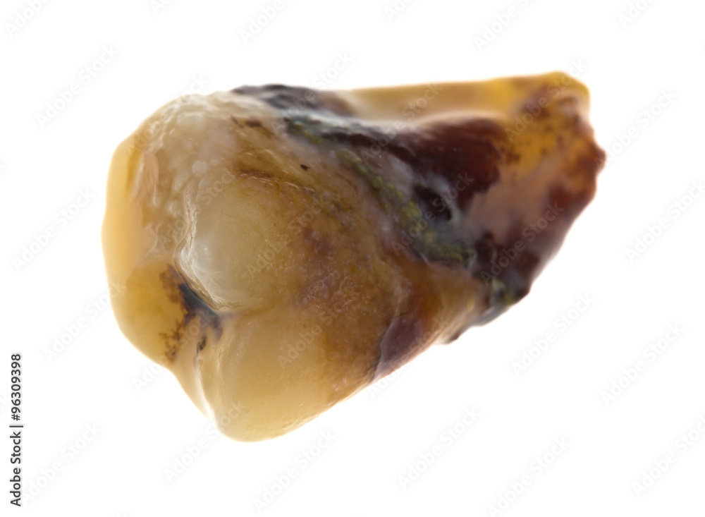 Decayed wisdom tooth Decayed wisdom tooth