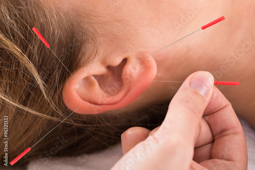 Hand Performing Acupuncture Therapy On Auricle photo