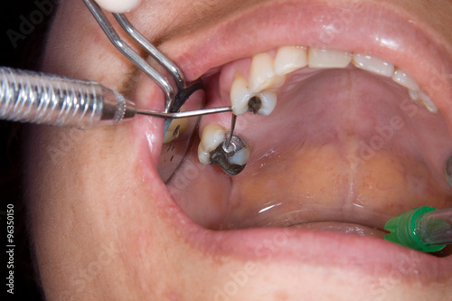 Canvastavla protesis parcial removible