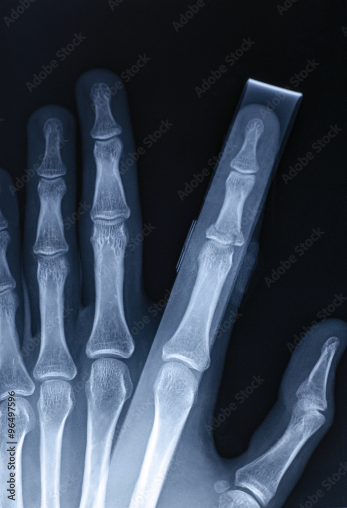 X-Ray image of human hand with stick