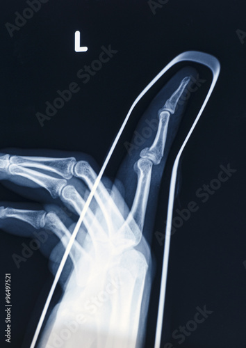 X-Ray image of human hand with stick