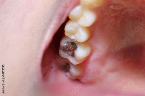 teeth cavity with the treatment