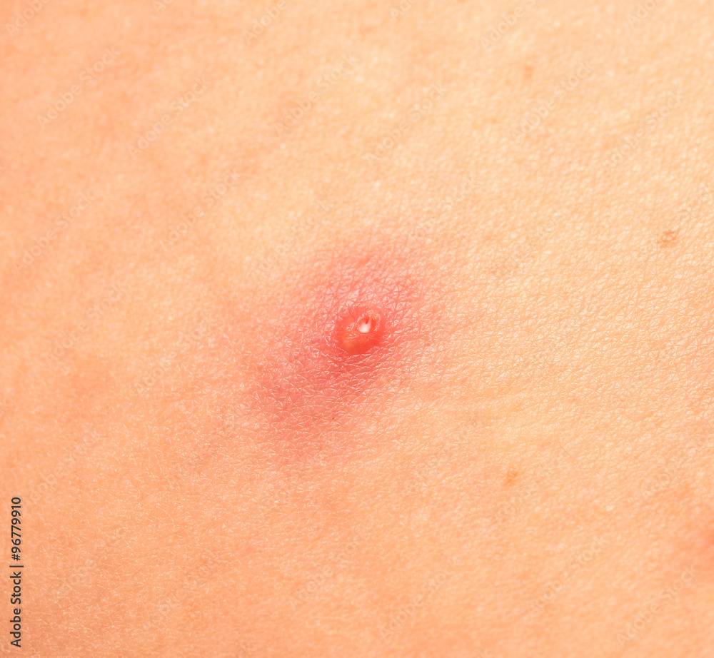 Fototapeta premium pimple