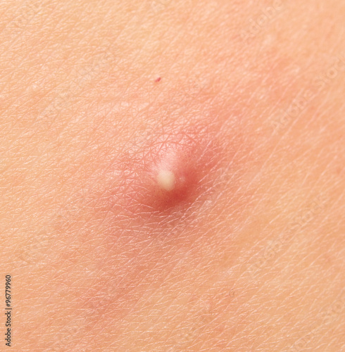 pimple