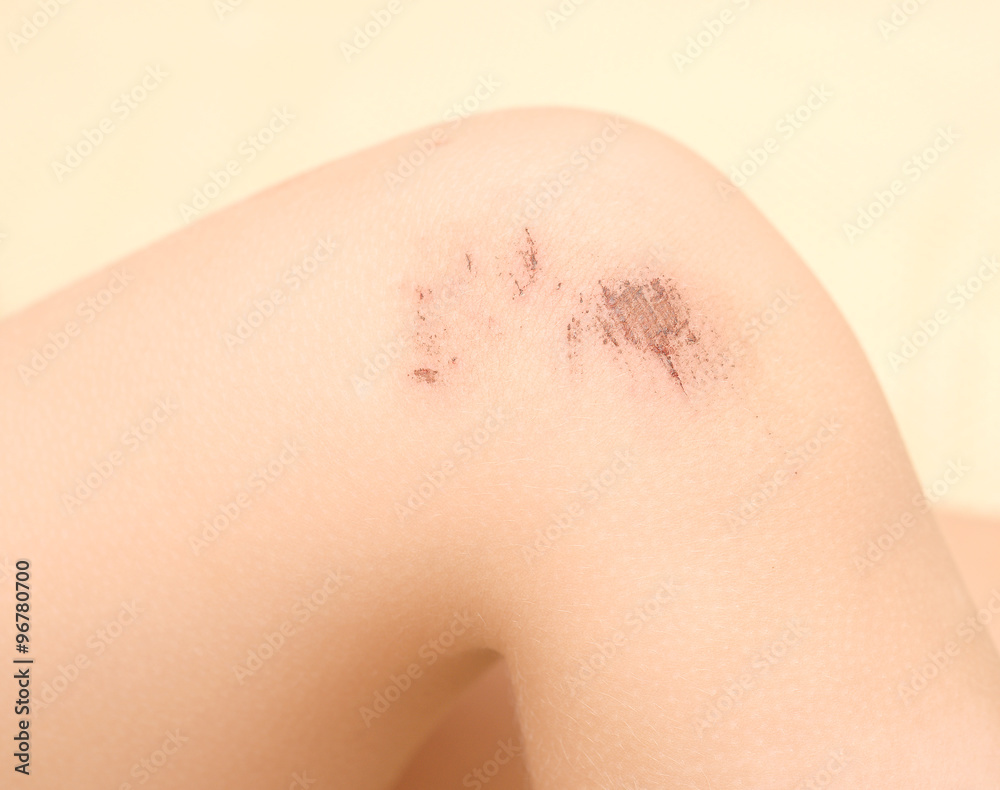 Fototapeta premium scraped knees