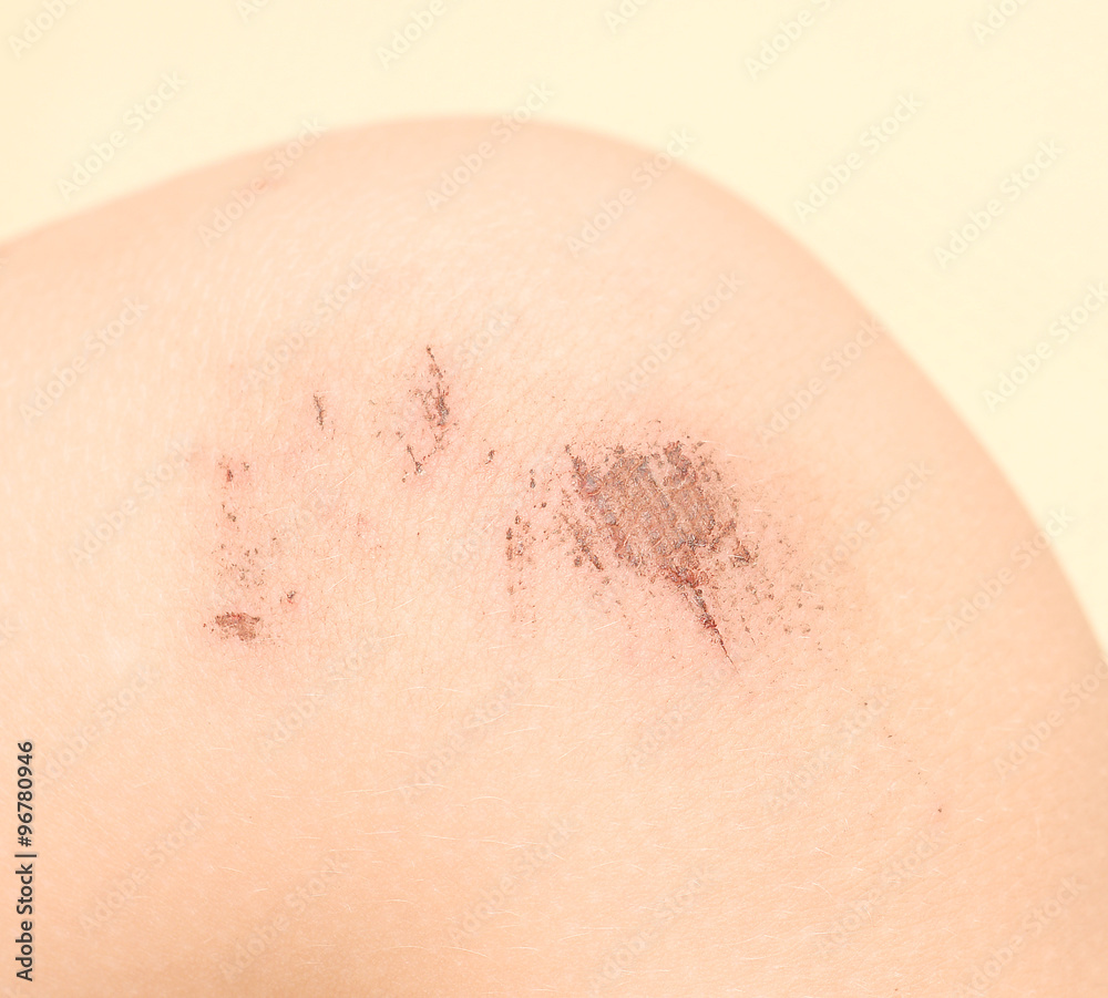 Fototapeta premium scraped knees