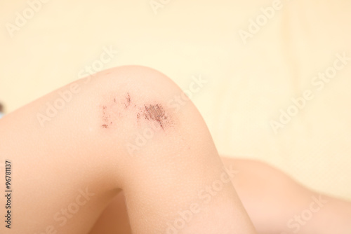 scraped knees