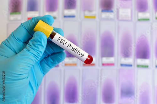 Epstein-Barr virus (EBV) positive photo