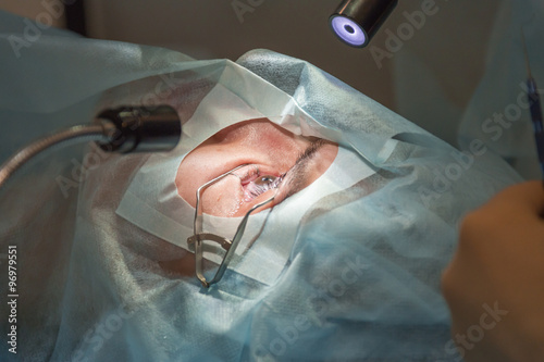 Stages of flap raising during lasik ophtalmology operation.