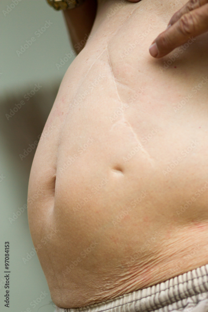Fototapeta premium The old man's stomach and a scar from the surgery.
