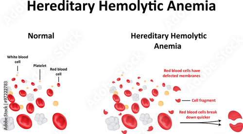 Hereditary Hemolytic Anemia photo