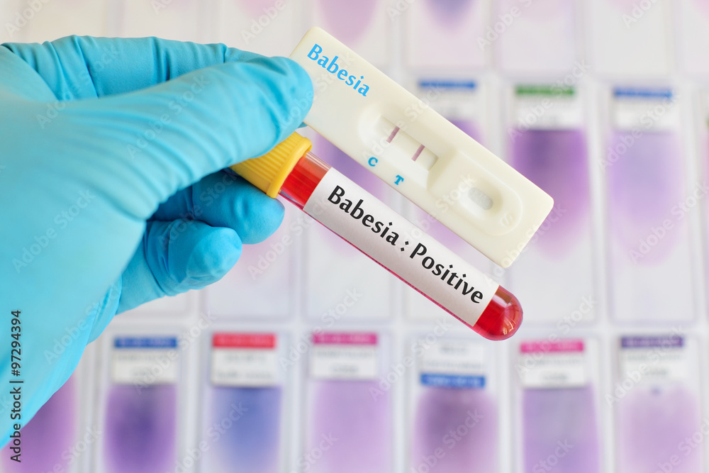 Babesia testing by using test cassette, the result showed positive (double red line)
Babesia testing by using test cassette, the result showed positive (double red line)