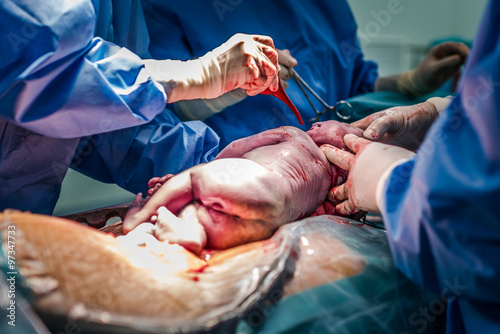 Classic cesarean section in the operating theater, labor room photo