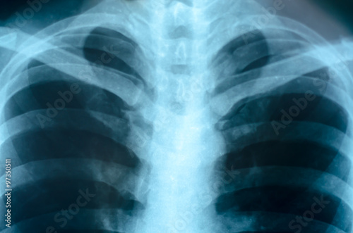 X-Ray Image Close up Of Human Chest