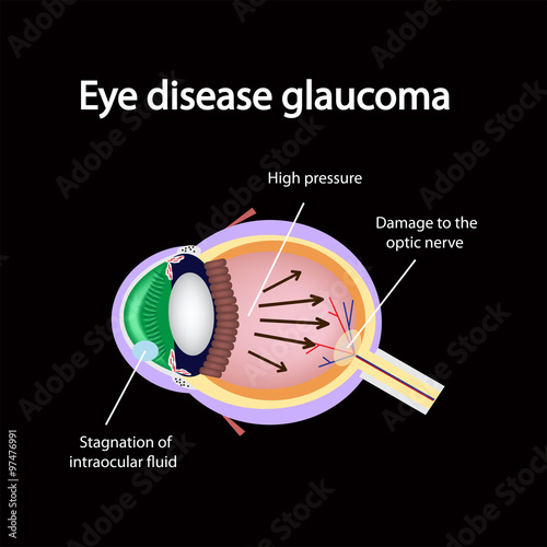 Glaucomatous eye. Violations causing glaucoma