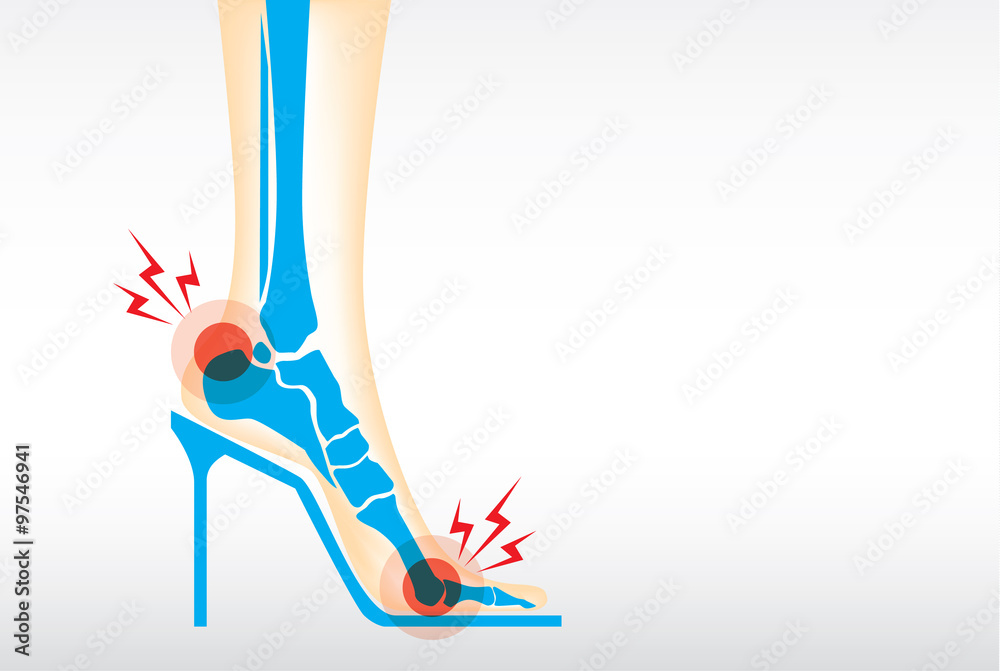 Symptom pain on foot because wearing high heels make heel bone damage
