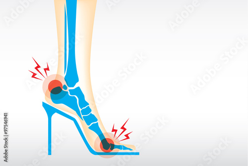 Symptom pain on foot because wearing high heels make heel bone damage and muscles.