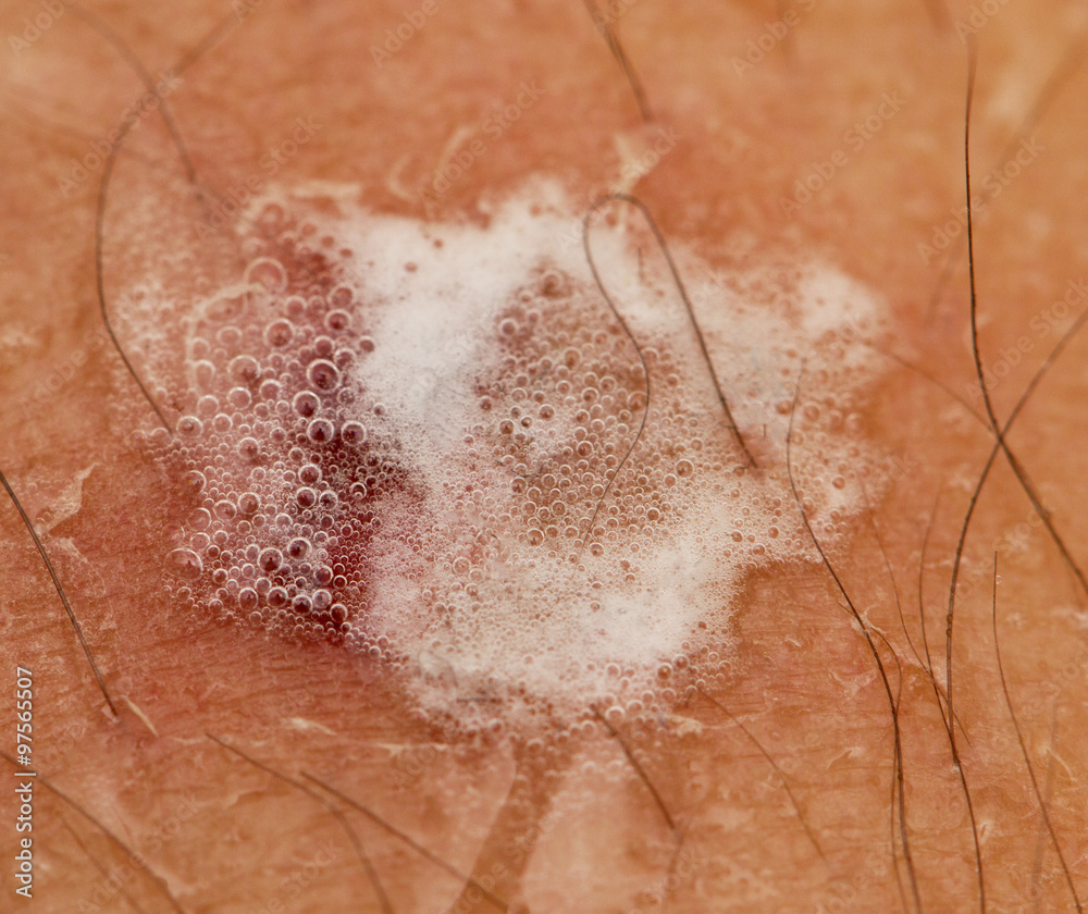 Fototapeta premium wound on the leg treated with peroxide