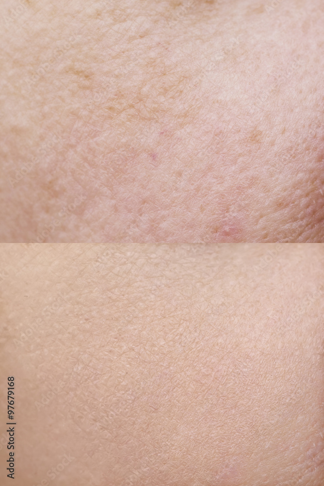 Fototapeta premium Skin before and after treatment