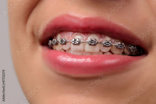 Close-up dental Braces on Teeth.