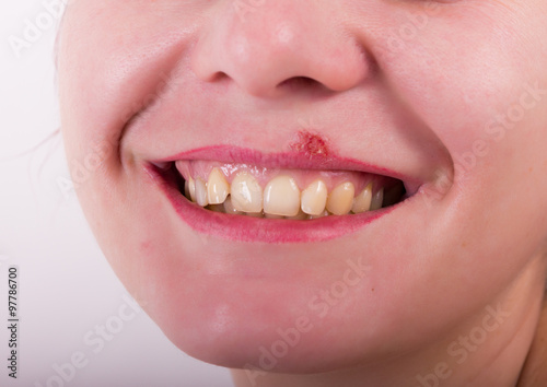 Girl lip diseased herpes. scabs on the stage of drying