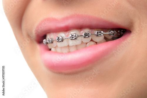 Close-up teeth with braces