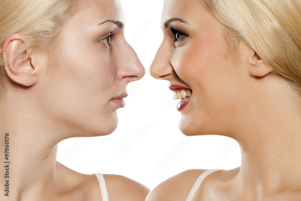 Profile of a young woman, before and after rhinoplasty Profile of a young woman, before and after rhinoplasty
